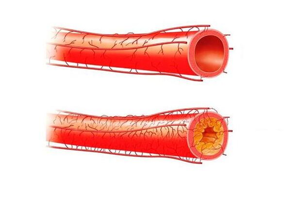 مشاكل الفاعلية بسبب الأوعية الدموية